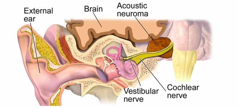 Acoustic neuroma diagram by Nevada Ear + Sinus Institute